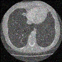 Noisy low-dose lung CT scan