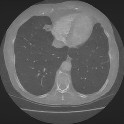 Denoised low-dose lung CT scan (ours)